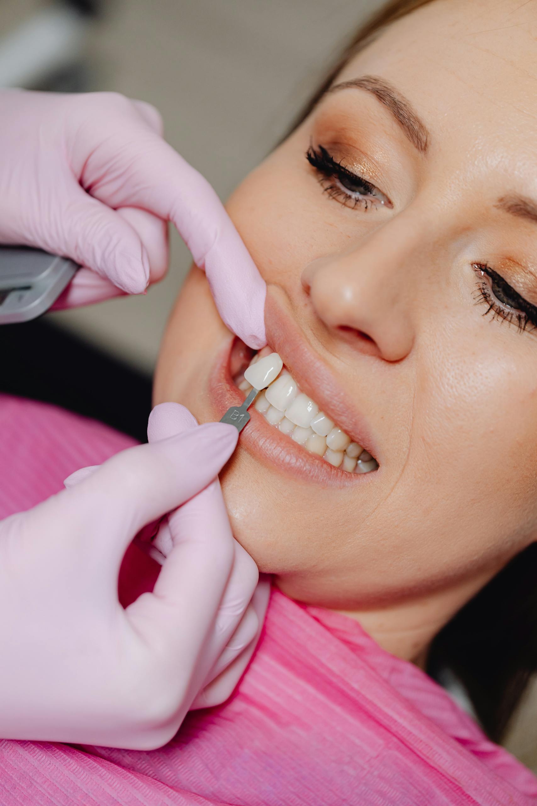 Detailed shot of a dentist applying veneer to a woman's teeth during a dental procedure.